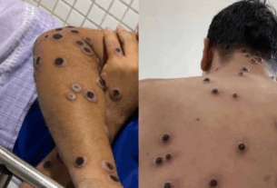 complicações da mpox
