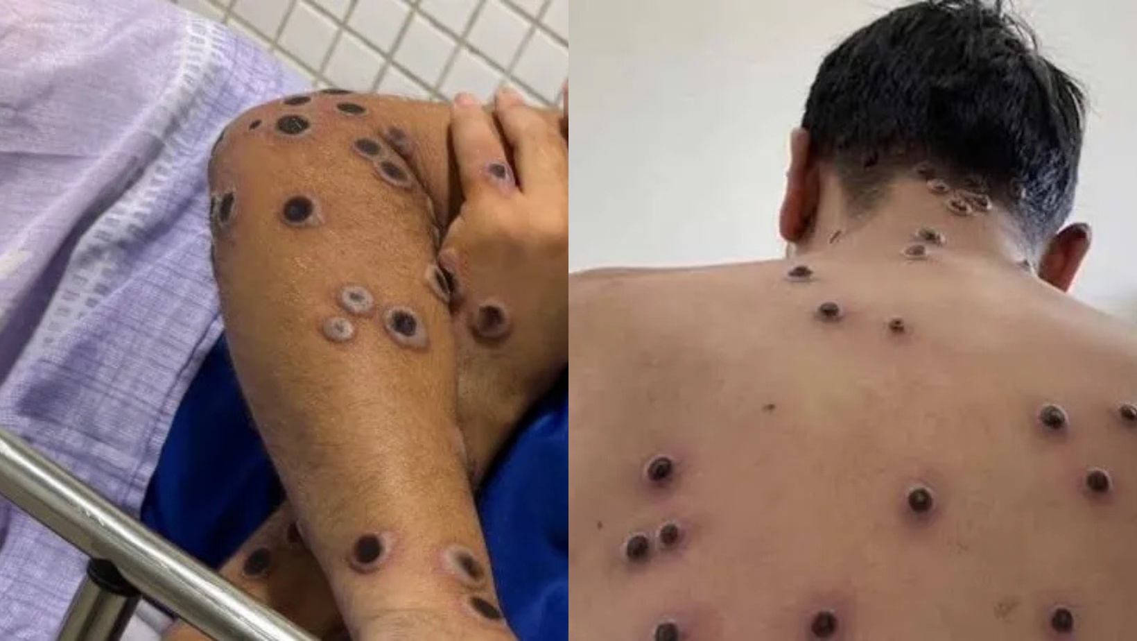 complicações da mpox