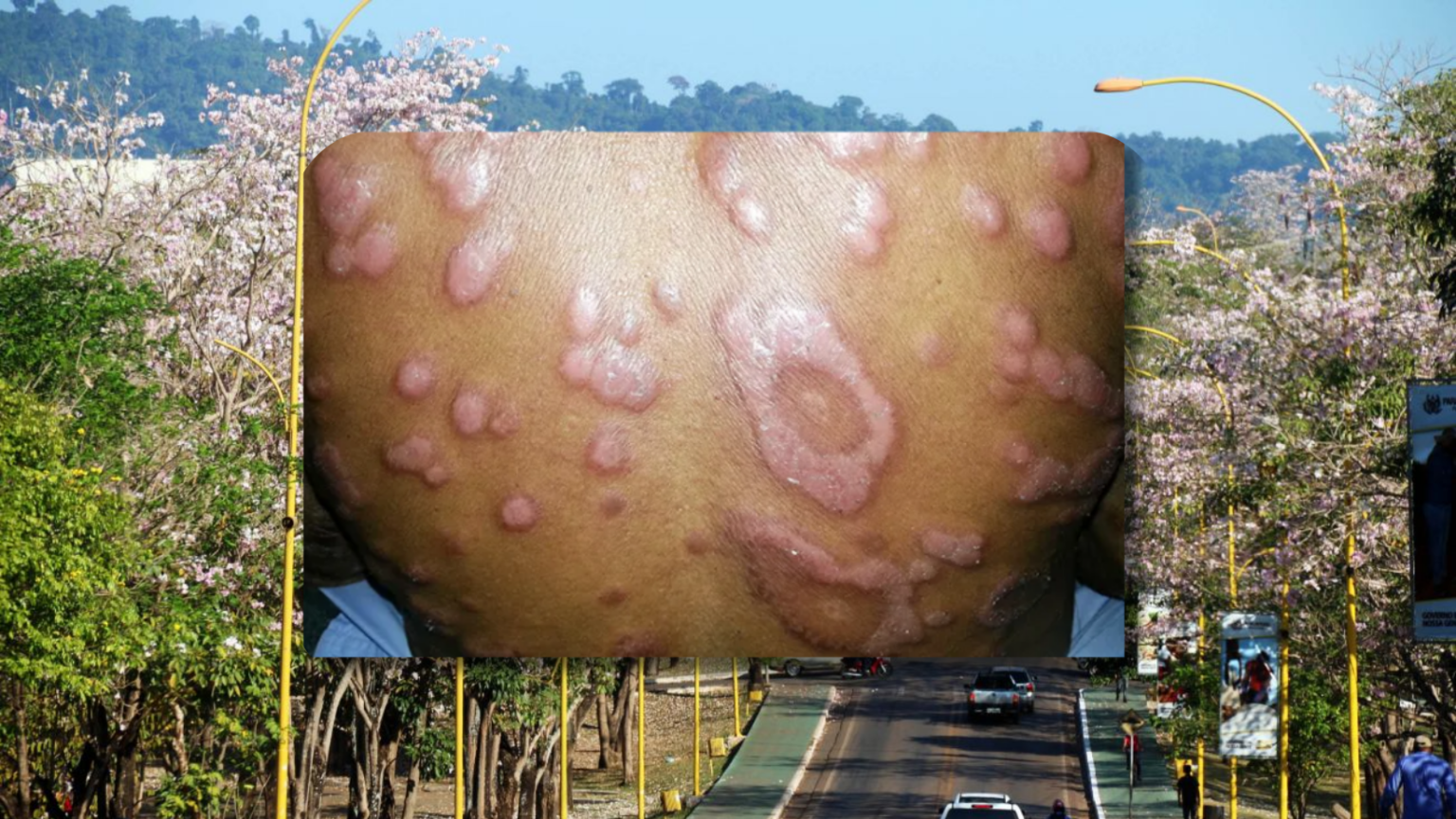 hanseníase em Parauapebas