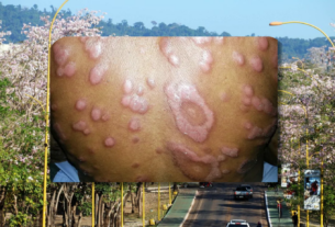 hanseníase em Parauapebas