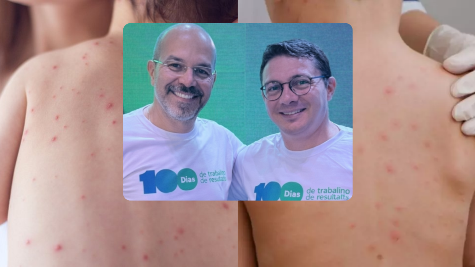 Surto de meningite Parauapebas