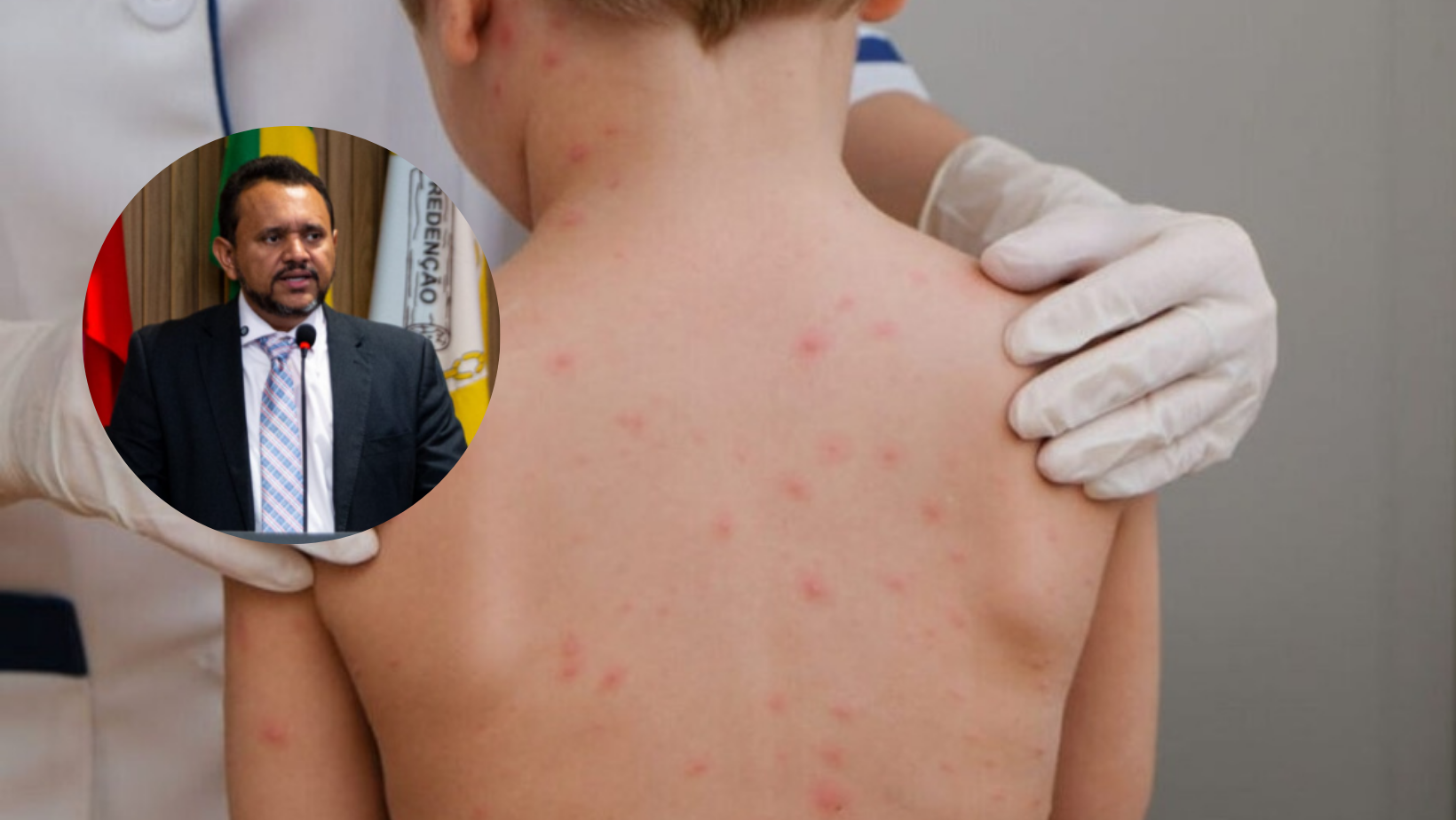 meningite suspeita Redenção Pará